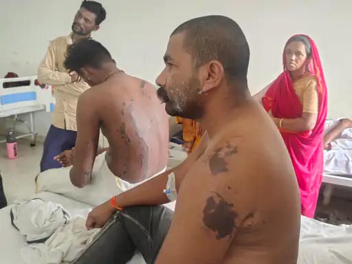 राजगढ़: कार-बाइक की टक्कर के बाद हुए विवाद में 6 लोगों पर एसिड अटैक, 2 1757674440 Untitled 3 copy